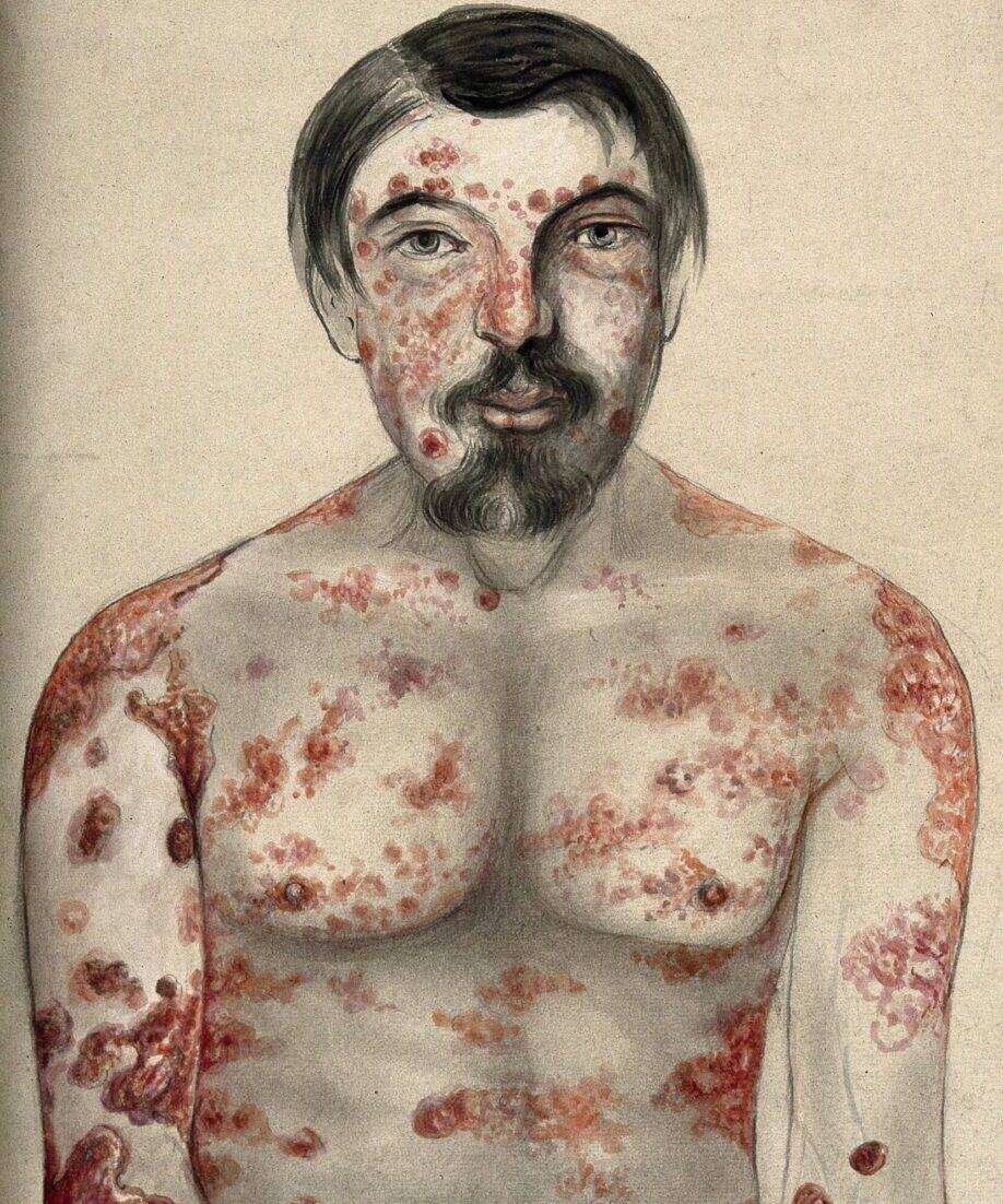 сифилис, здраве, полово-предавани болести, венерически болести, твърд шанкър, шанкър