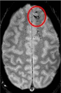 Критерии за извършване на скенер на глава при травма при #1 възрастни и #2 деца 6 скенер на глава, малък кръвоизлив