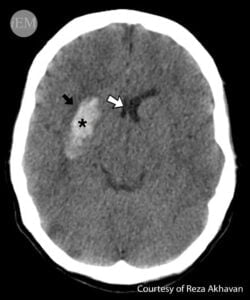 Критерии за извършване на скенер на глава при травма при #1 възрастни и #2 деца 5 скенер на глава, кръвоизлив