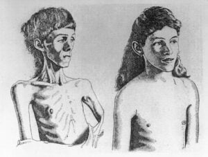 5 опасности на 3 вида хранителни разстройства 4 Анорексия нервоза