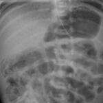 метеоризъм, болки и подуване в корема, рентгенова снимка на газове в червата