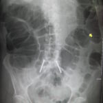 метеоризъм, газове в червата, остра чревна обструкция, остра чревна непроходимост