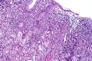 Остър гастрит - симптоми, диагностика и лечение 5 остър гастрит, клинична находка и картина