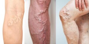 Оток на крака - от какво може да е? 5 оток на крака, дълбока венозна тромбоза