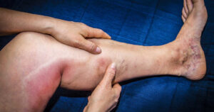 Оток на крака - от какво може да е? 4 оток на крака, дълбока венозна тромбоза, повърхностни вени