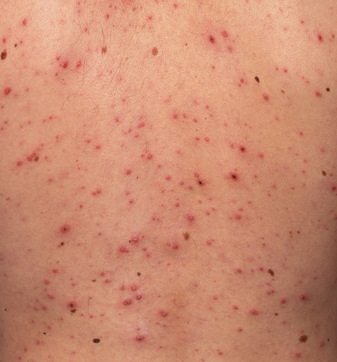 варицела, дребна шарка, обрив, варицела-зостер