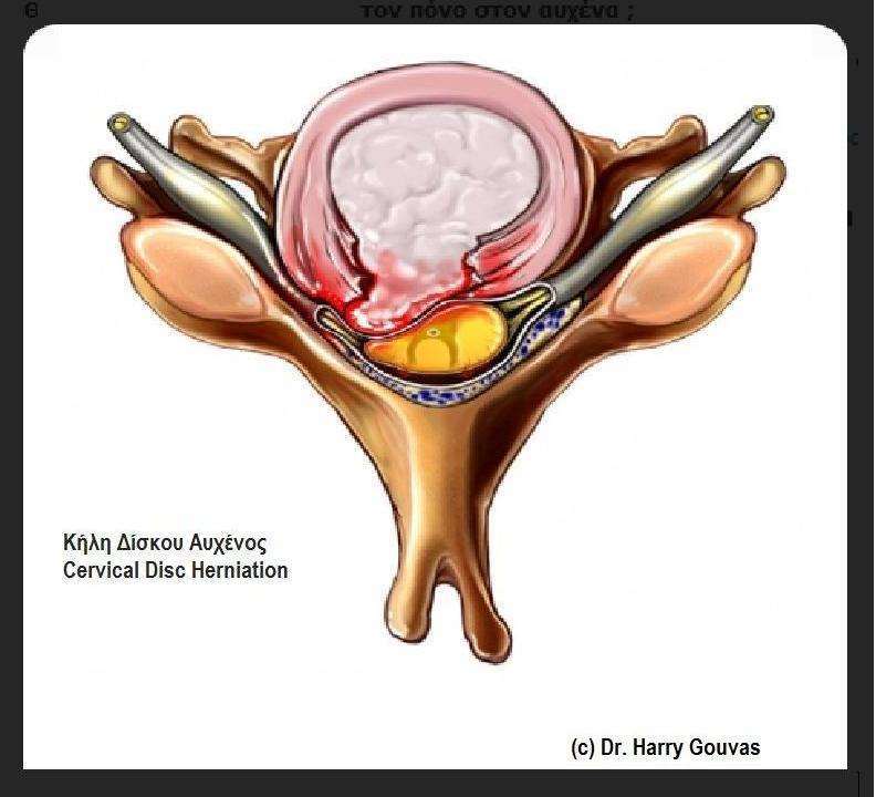 дискова херния, болка в гърба, херния
