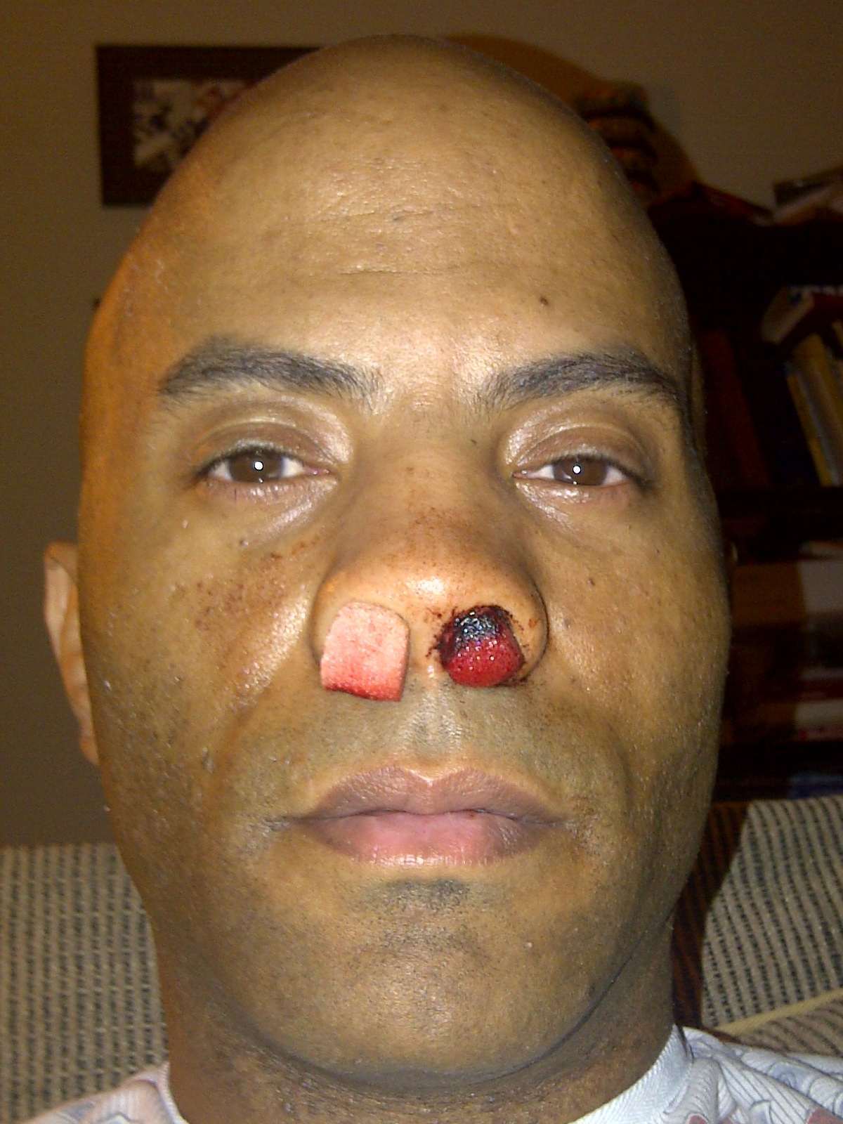 епистаксис, кръвотечение, остро кървене от носа