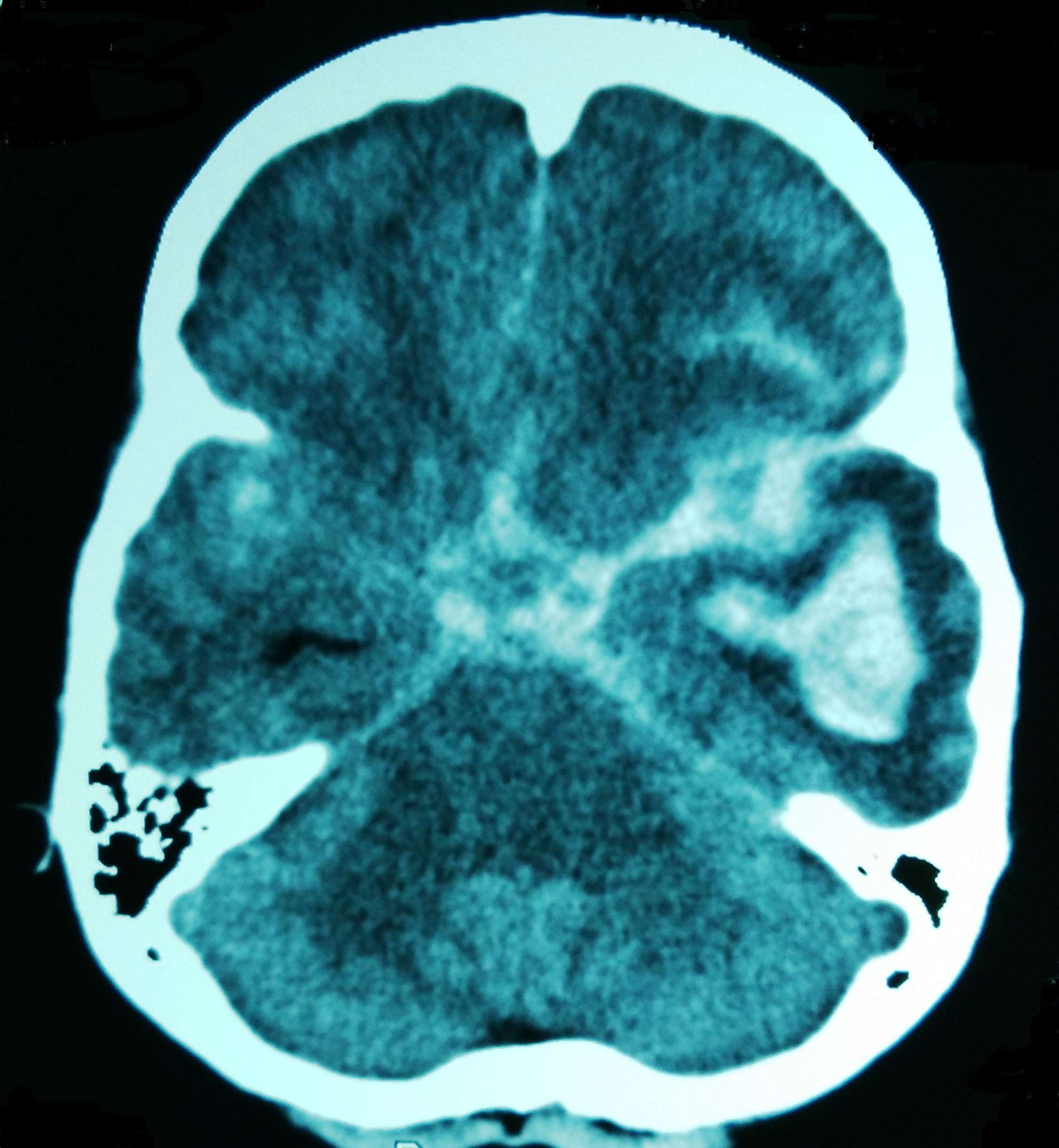 Субарахноидален кръвоизлив - същност и лечение 4 субарахноидален кръвоизлив