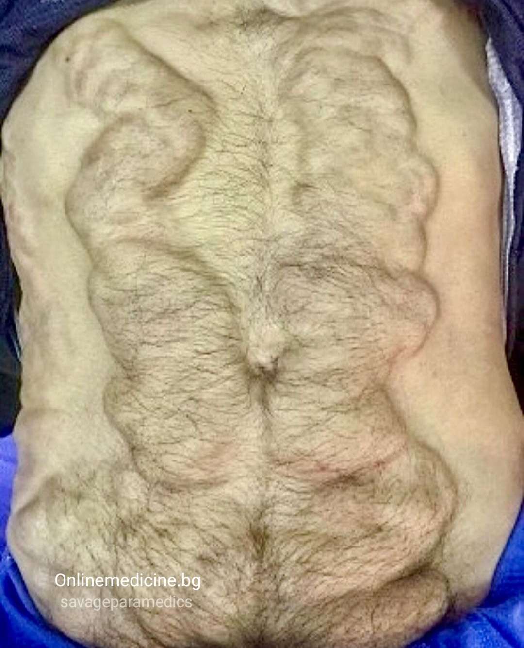 портална хипертония