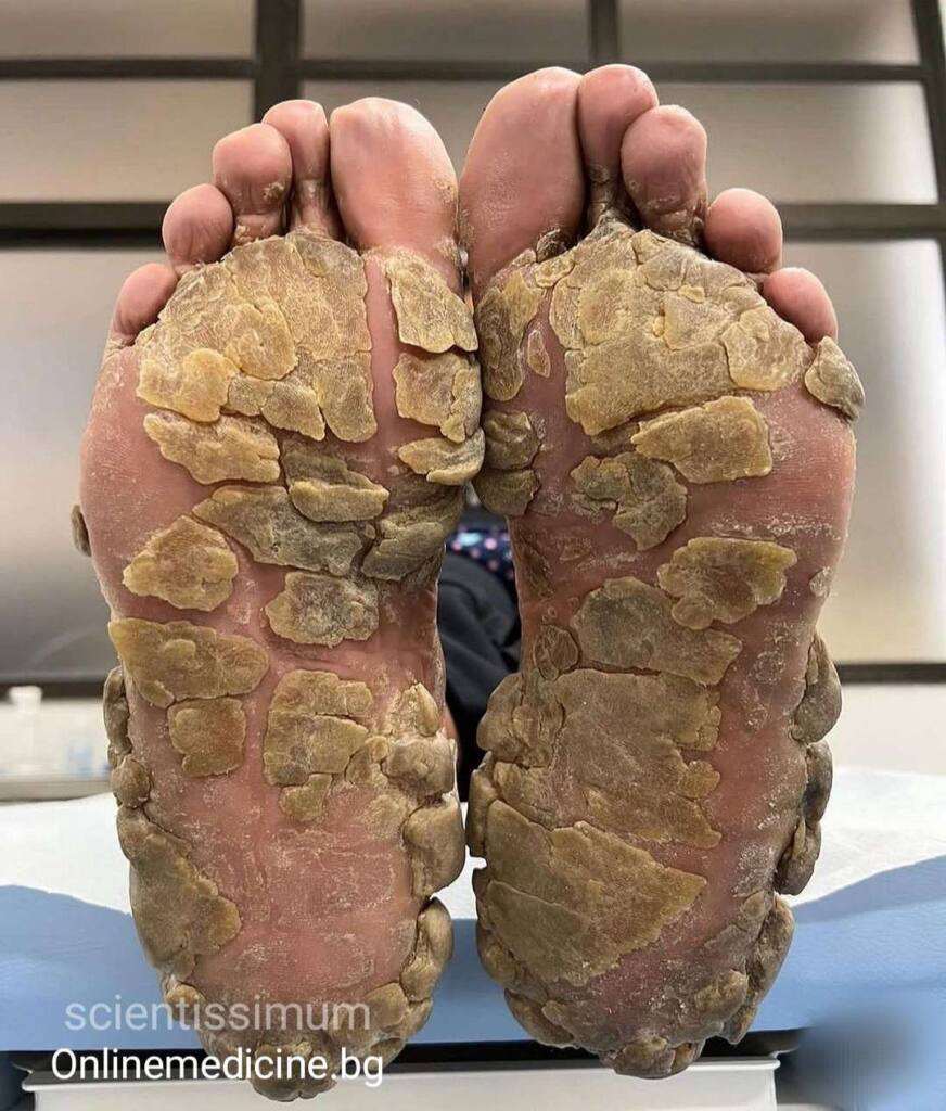 Клиничен казус 7 "Синдром на Базекс": Болезнена паронихия 25 Dermatologichen kojen problem sindrom na Bazex