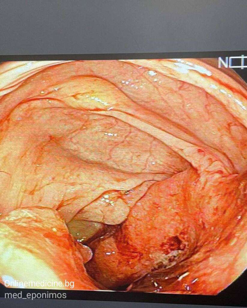 Dermatologichen kojen problem sindromat na Bazex