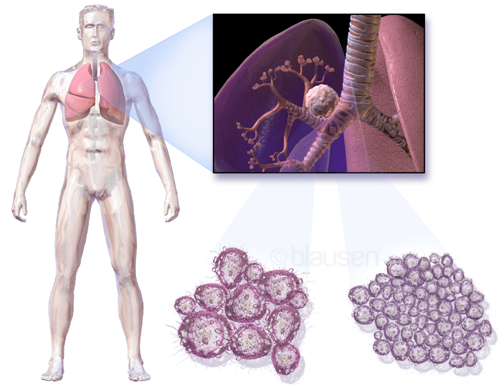рак на белия дроб, белодробен рак, рак на бял дроб, бял дроб