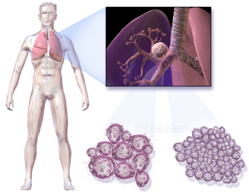 Рак на белия дроб: Ранни симптоми при 2 основни вида на заболяването 4 рак на белия дроб, рентгенова снимка на гръден кош