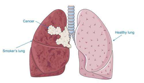 Рак на белия дроб: Ранни симптоми при 2 основни вида на заболяването 3 рак на белия дроб рак на бял дроб scaled e1709465241341