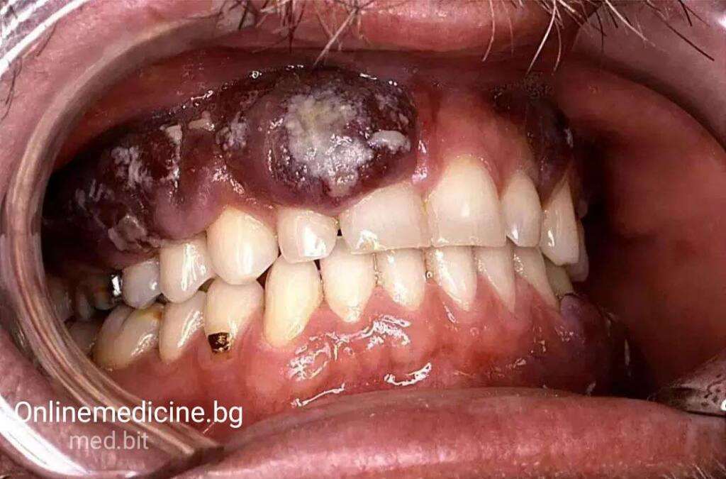 Клиничен казус 8 ,,Сарком на Капоши'': Кожни лезии 17 Sarcoma na Kaposhi rak na kojata