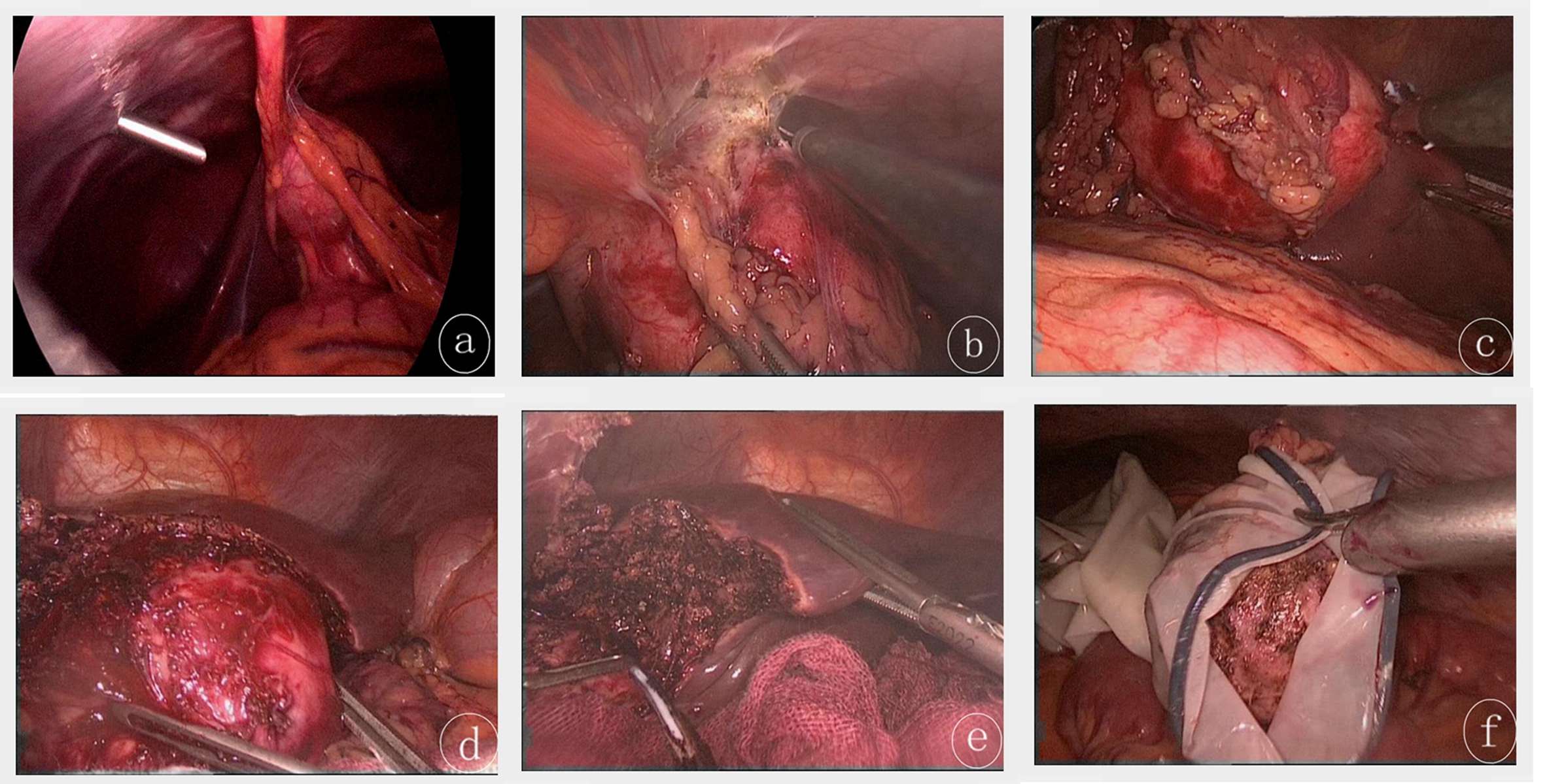 Ехинококоза на черния дроб