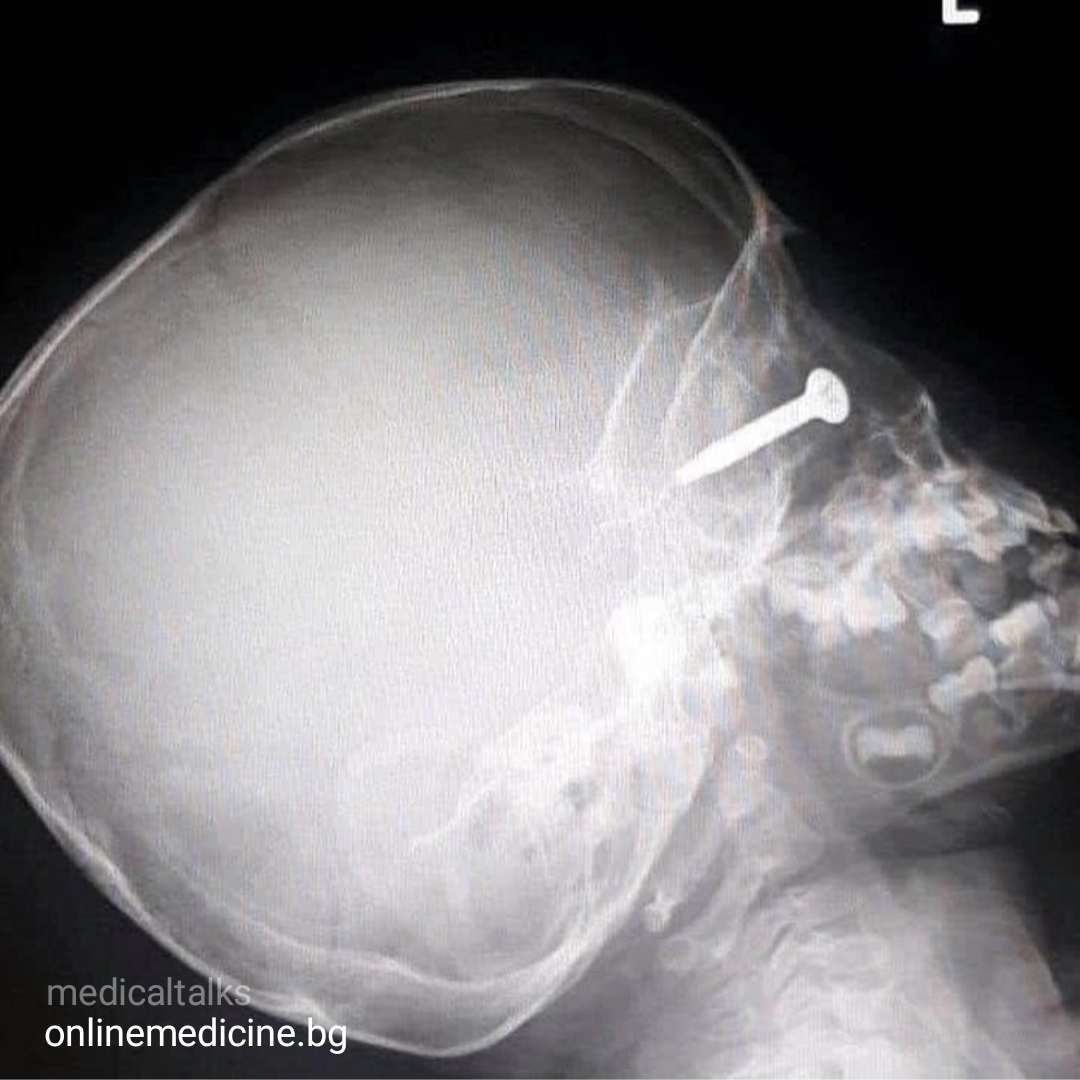 bolt v okoto vizualizirano na rentgenova snimka