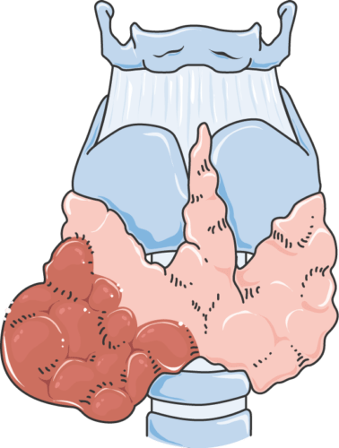 Хиперпаратиреоидизъм - 2 основни причини за повишаване на паратхормона 4 Хиперпаратиреоидизъм, рак на щитовидна жлеза