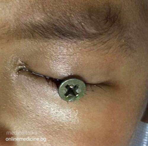 Клиничен казус 11: Чуждо тяло в окото 5 винт в околото на детето