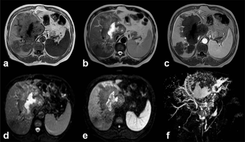 Ехинококоза на черния дроб- заболяване причинено от тения - 4 съвета за превенция! 4 ехинококова киста в черния дроб, КТ