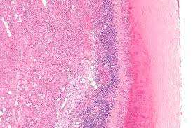 Ехинококоза на черния дроб- заболяване причинено от тения - 4 съвета за превенция! 3 чернодробна киста