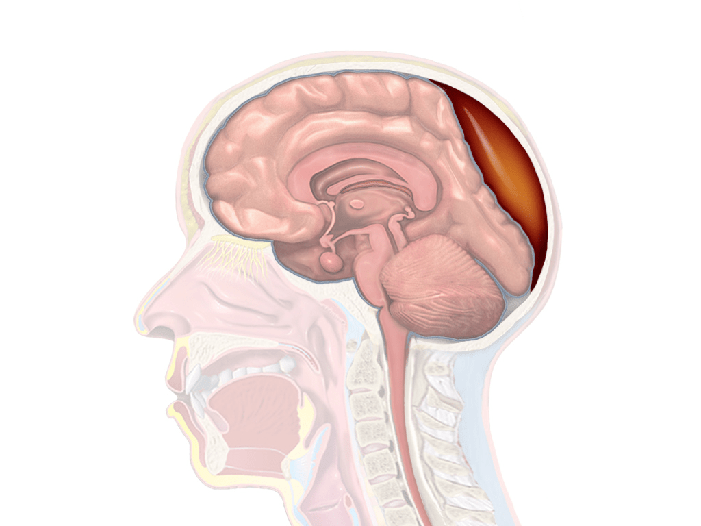 epiduralen Hematom