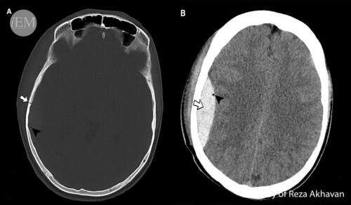 Епидурален хематом - как да го разпознаем без медицински познания? 5 основни симптома на състоянието 3 епидурален хематом, снимка от КТ