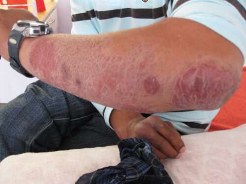 Лепра - позната още като "проказа" - 12 клинични особености на заболяването 4 лепра-проказа