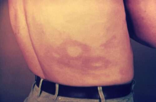 Лепра - позната още като "проказа" - 12 клинични особености на заболяването 5 лепра-проказа-кожна лезия