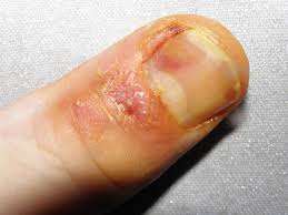 Панарициум - 3 форми на състоянието, симптоми и лечение 3 панарициум на пръста
