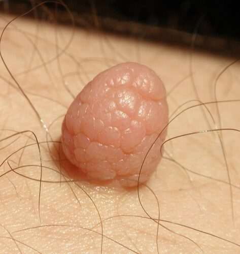 Доброкачествени тумори по кожата 7 доброкачествени тумори на кожата, фибром по кожата