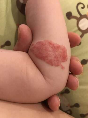 Доброкачествени тумори по кожата 9 доброкачествени тумори на кожата, хемангиом по кожата