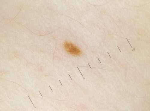 Доброкачествени тумори по кожата 6 доброкачествени тумори по кожата, невус по кожата